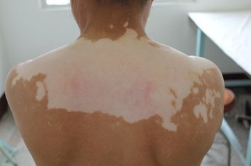 为什么背部白癜风也需要及时的治疗?(图1)